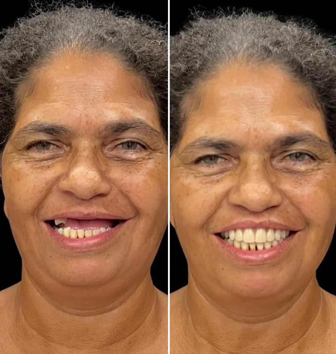 Paciente antes e depois da reabilitação com dentes fixos