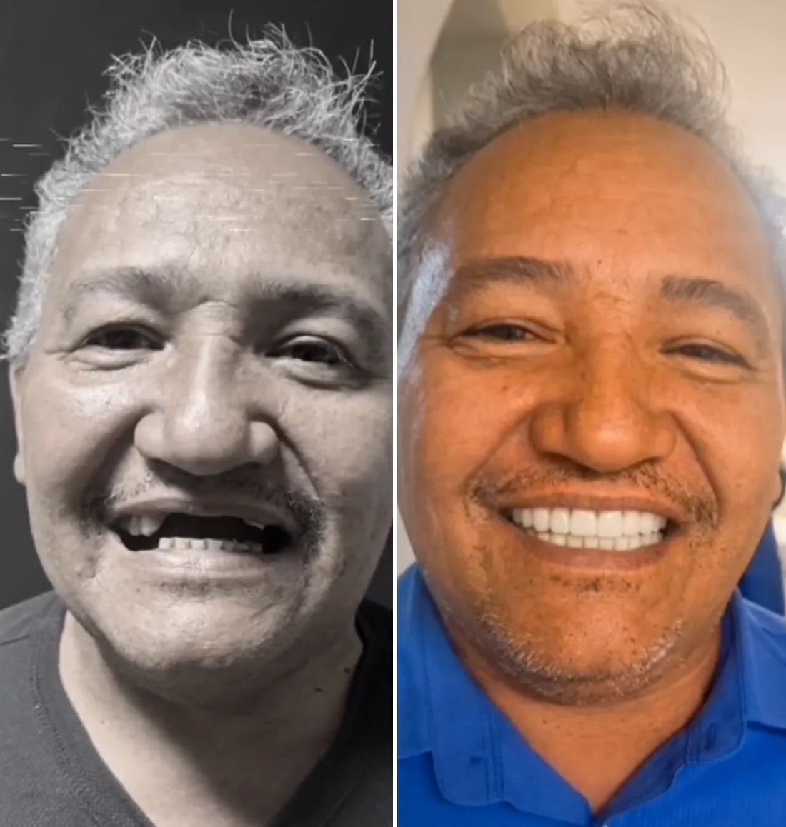 Paciente antes e depois da reabilitação com dentes fixos