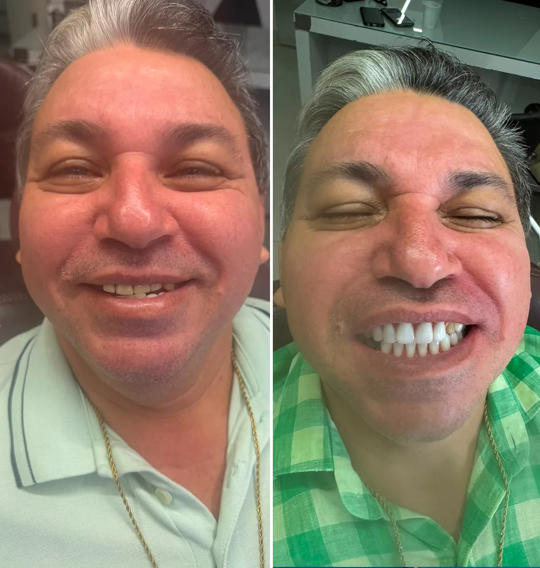 Paciente antes e depois da reabilitação com dentes fixos