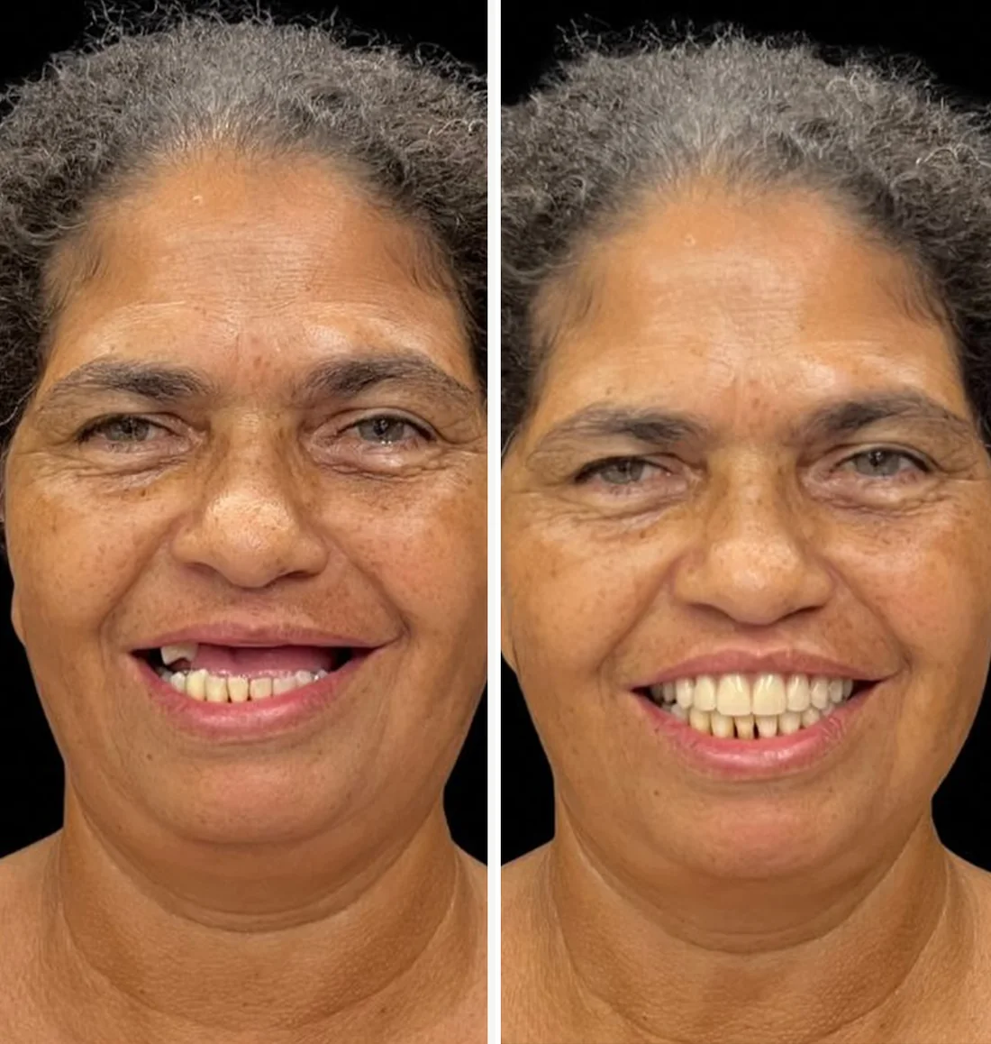 Paciente do Dr. Arivani antes e depois da reabilitação com dentes fixos